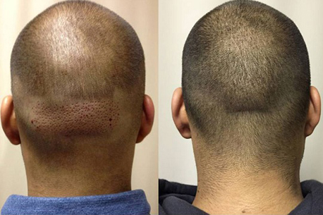 fue-hair-transplant