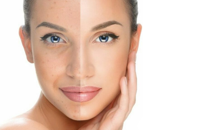 pigmentation